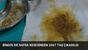 Bingöl'de Safra Kesesinden 2067 Taş Çıkarıldı
