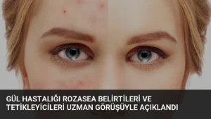 Gül Hastalığı Rozasea Belirtileri ve Tetikleyicileri Uzman Görüşüyle Açıklandı