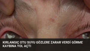 Kırlangıç Otu Suyu Gözlere Zarar Verdi Görme Kaybına Yol Açtı