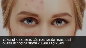 Yüzdeki Kızarıklık Gül Hastalığı Habercisi Olabilir Doç Dr Sevgi Kulaklı Açıkladı