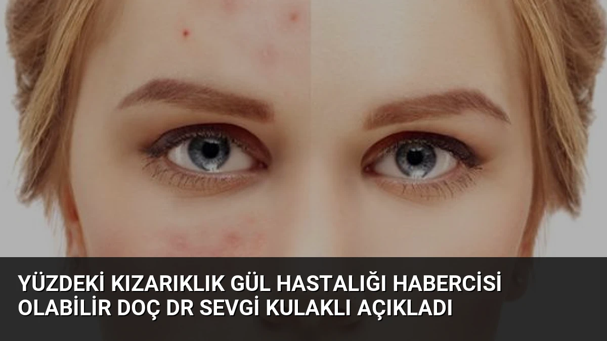 Yüzdeki Kızarıklık Gül Hastalığı Habercisi Olabilir Doç Dr Sevgi Kulaklı Açıkladı